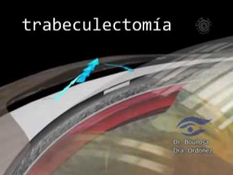 Trabeculectomía