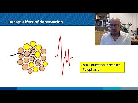Needle EMG: normal vs neuropathic MUPs