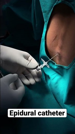 Epidural catheter insertion #anesthesia