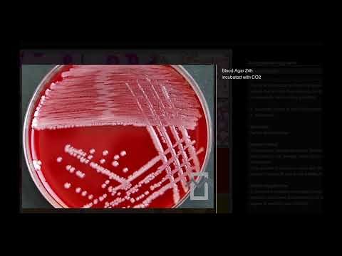 Acinetobacter Baumanii: The Silent Threat in Healthcare.