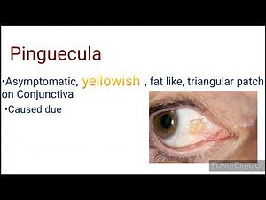 Pinguecula | Pterygium | short notes and differential diagnosis | Conjunctiva