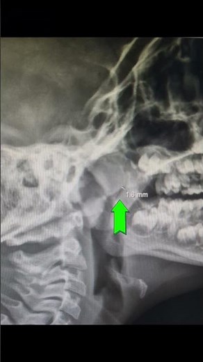 Lateral cavum X-ray