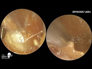 1,654 - Q-Tip Compacted Ear Wax Microsuction Removal