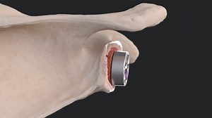 Bone Graft Preparation for Univers Revers™ Modular Glenoid System
