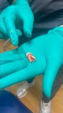 Raw dog tooth extraction 🦷 #dentist #tooth #extraction #oralsurgery #chain