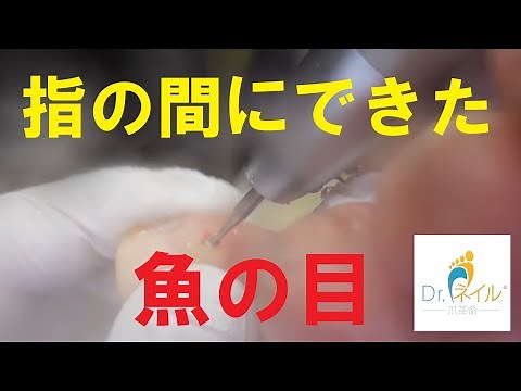 「魚の目」の芯の取り方（胼胝・callus・脚茧）（うおのめ・ウオノメ・魚の目・鶏眼・Corn・티눈・鸡眼）015