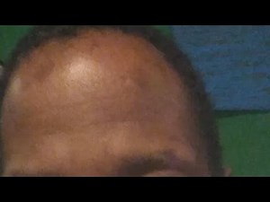 Diclofenac Sodium Topical Gel 1%