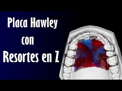 Placa Hawley con Resortes en Z | Elena Dental Art & More