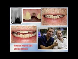 Osseointegration | How Dental Implants fuse to bone