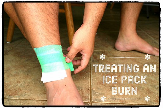 How to Treat a Cold Pack Burn