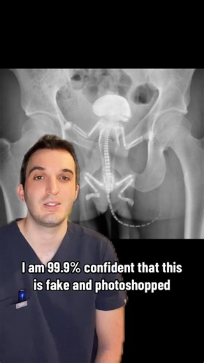 Doctor Justin (M.D) - Medicine, Health, & Radiology on Instagram: "Say no to gerbilling 🐹 #medicine #doctor #doctors #doctorsoftiktok #medstudent #medicalstudent #medschool #medicalschool #medtok #doctorlife #tiktokdoc #tiktokdoctors #radiology #radiologist #radiologia #emergency #emergencyroom #emergencymedicine #gerbil #gerbils #gerbilsoftiktok #ctscan #xray"