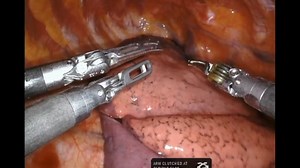 Robotic Thoracic Surgery - Robotic Right Lower Lobectomy - Easiest