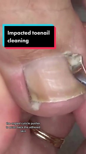 Effective Tips for Impacted Toenail Care and Pedicure