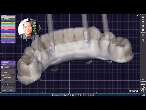 Inner Bar (iBar) Split Design on exocad 3.3 Chemnitz