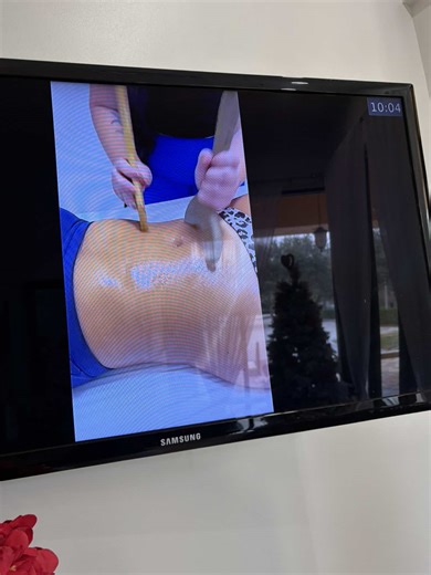 Hey Sista’s i promised to keep yall in the loop so here are a few updates girlys 🎀🥹🫶🏾 #fyp #liposuction #airsculptjourney #airsculpt