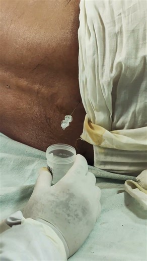 CSF fluid #lumbarpuncture #medicalstudent #nursingstudent #trendingvideo #viralvideo