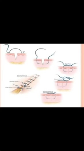 medical videos on Instagram: "Every surgical procedure is not only a science but also an art. The types of sutures reflect a surgeon’s precision, patience, and skill. Each thread, each knot represents small yet vital steps toward the healing of the human body. #SurgeryLife #TypesOfSutures #SurgicalArt #PrecisionMatters #HealingHands"