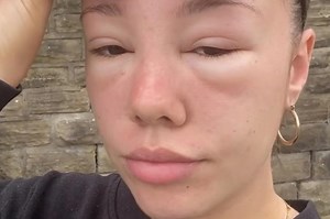 What is sun poisoning? Condition caused woman's eye area to swell up on holiday