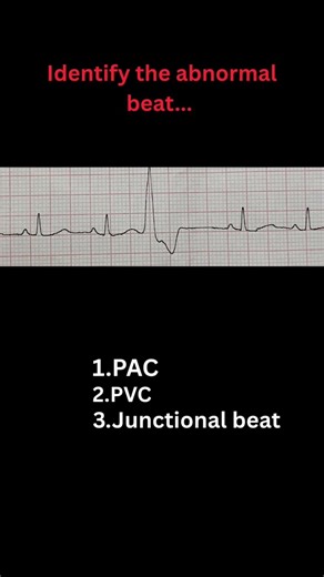 IDENTIFY THE ABNORMAL BEAT IN ECG #cardiology #medicalshorts #shorts #viralshorts