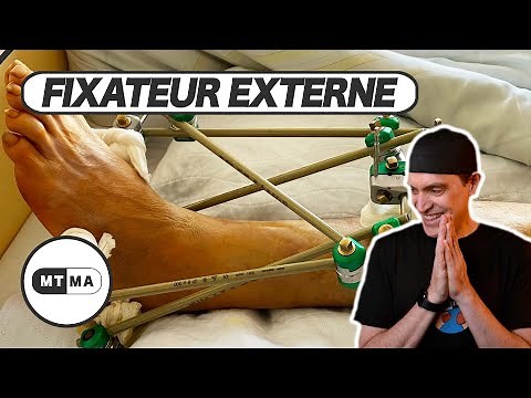 External fixator - How does it work and why do we do it?