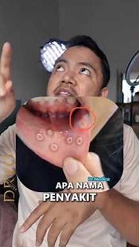Sariawan Banyak + Gusi Bengkak? Bisa Jadi Herpetic Gingivostomatitis!
