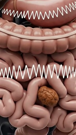 Constipation in 3D Animation | Watch Your Intestines Struggle