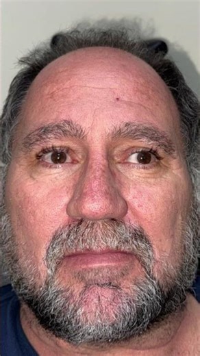 How to treat a Exotropia squint with prisms and Visual Therapy #Prisms #Exotropia #VisionTherapy