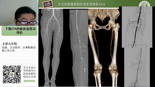 下肢CTA的检查流程及评价-中大张健