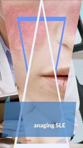 Mixed Connective Tissue Disease and Lupus