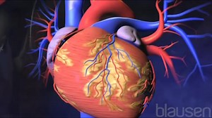 Ablation par radiofréquence