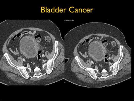 Bladder Cancer More images here: https://ctisus.com/responsive/teachingfiles/genitourinary/393994 | CTisus: Cutting edge information on body CT (Computed tomography).