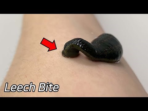 Strange Scars on Leech Bite !