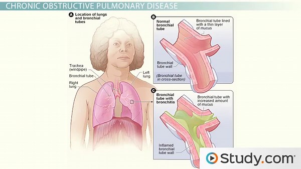 The Causes of Chronic Obstructive Pulmonary Disease (COPD)