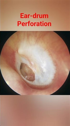 Perforated Ear drum (tympanic membrane) #entdoctor #eardrumperforation #eardischarge #earproblem