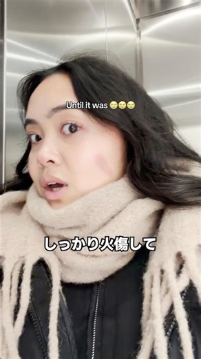 ヘアアイロンの火傷跡はどれくらい残る？