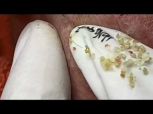 Loan Nguyen Acne Treatment 1144q