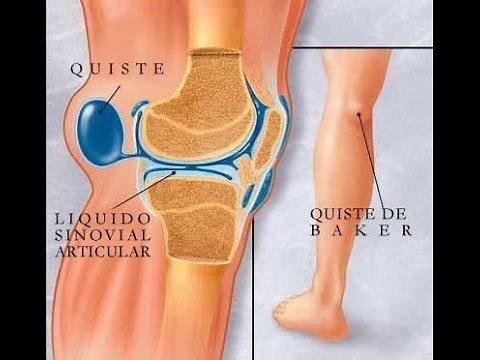 Quiste de Baker o popliteo (Rodilla)