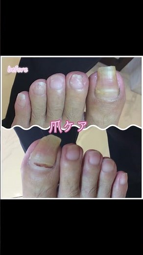 約2ヶ月ぶりの爪切り💖爪切りでお困りの際はドクターネイル爪革命にお越し下さい！