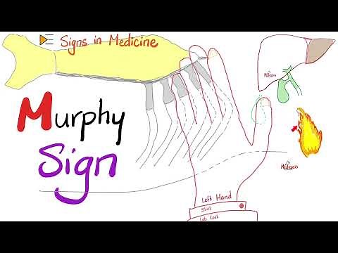 Murphy Sign for Cholecystitis | Signs in Medicine Series