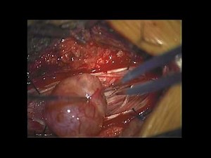 Intradural Tumor in Lumbar Region • Video • MEDtube.net