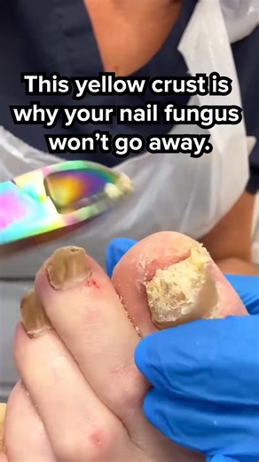 Tired of hiding your nails? 💅 Say hello to open-toe confidence in just 2 weeks. The Orivelle Nail Pen doesn't just cover up the problem—it goes deep to fight the fungus at its source. ✅ Targets the nail root ✅ Easy 10-second daily application ✅ Noticeable results in days ✅ Backed by science and a 30-day guarantee Don't wait for it to spread. Start your treatment today | Orivelle