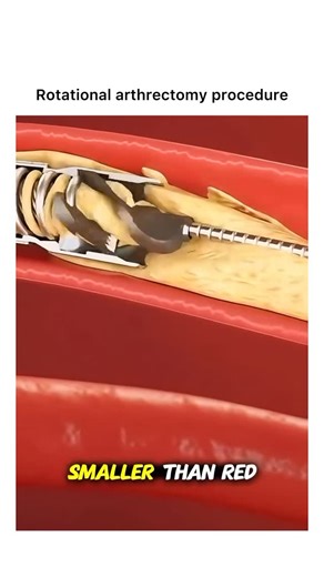 Animations on Instagram: "Follow @surgicalanimation for more! "