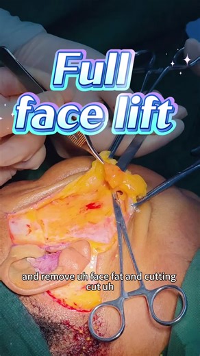 #fullfacelifting#Bigfacelift #Drleouteam Dear friends, This is a deep, professional.Real full face lift surgery.Different from lines, different from mini face lift, different from face injection, different fromThe effect of any technique and any equipment, because this is a complete change.This is a very difficult professional surgery, which is more suitable for people over 45 years old.Or stay up late for a long time, facial fat and collagen are lost, and there is serious looseness and sagging.