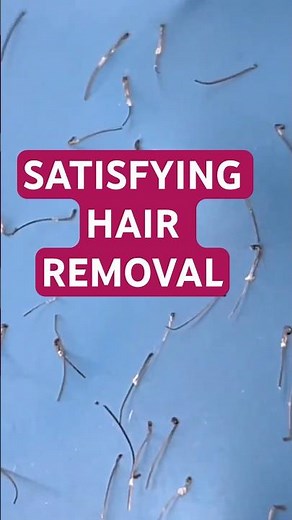 Satisfying footage of electrolysis permanent facial hair removal for PCOS, PMOS, Hirsutism