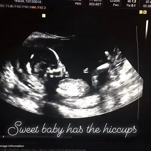 9.6K views · 50 reactions | When baby has hiccups in the womb they...