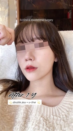 EU Oral&Maxillofacial Surgery on Instagram: "I used to struggle endlessly with a complex about my jaw. Dr. Shin, Hee Jin ( @dr.shin_heejin ) 💖 Now I’ve gained enough confidence to even try a short haircut 💖 🔸 Aesthetic concerns: Protruding jaw + Malocclusion 🔸 Procedures: Double jaw surgery + Facial contouring surgery x-x-x-x-x-x-x-x-x-x-x-x-x-x-x- 📞 Phone consultation: +82-2-547-0101 📳 KakaoTalk consultation: @이유구강악안면외과 📺 YouTube: Search “이유구강악안면외과” Real model applications 📩 Please foll