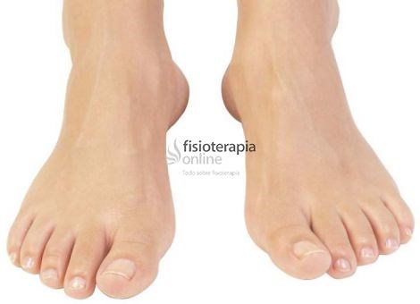Sesamoiditis: Todo lo que necesitas saber sobre esta patología