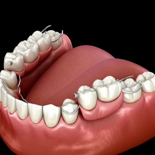 Removable partial denture (RPD) #rpddentalprocedure #removabledenture
