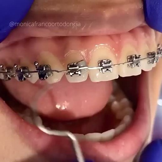 Self-ligating brackets 😷By monicafrancoortodoncia-ig