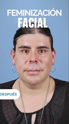 FEMINIZACIÓN FACIAL